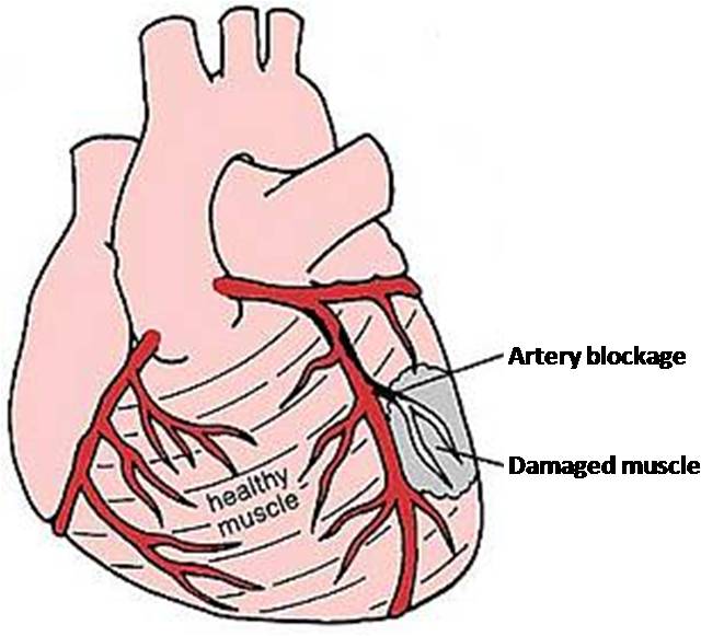 Heart attack damage