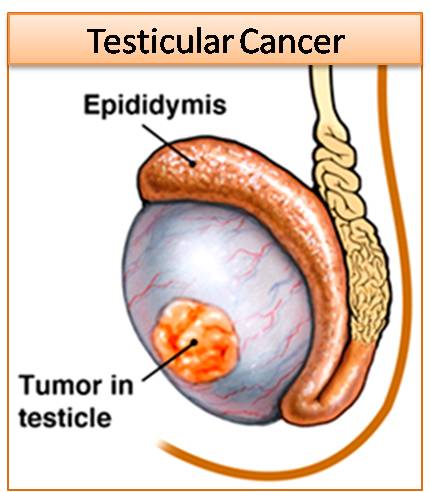Warning signs of testicular cancer