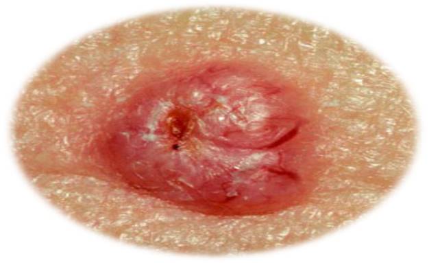 Skin cancer- basal cell