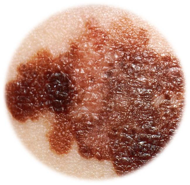 Skin cancer