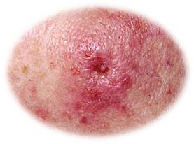 Skin cancer- squamous cell